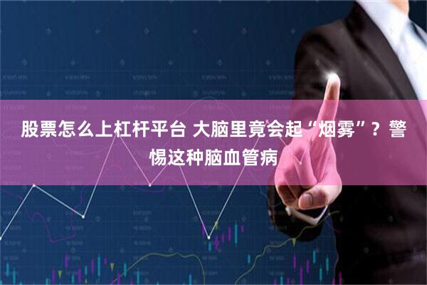 股票怎么上杠杆平台 大脑里竟会起“烟雾”？警惕这种脑血管病